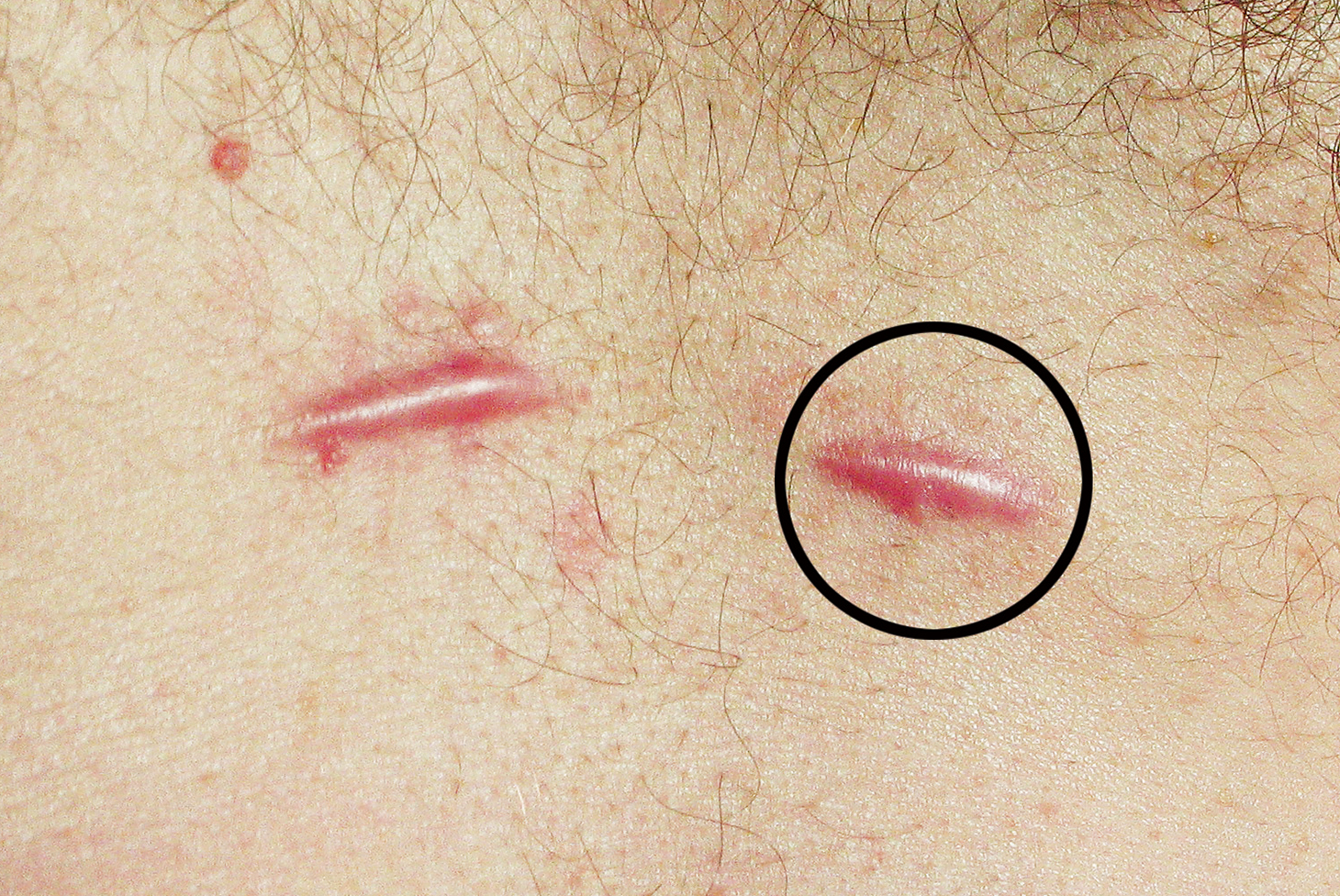 Before treatment