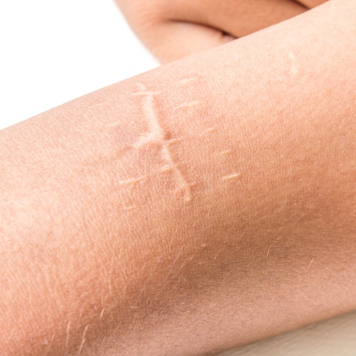 Different types of scars